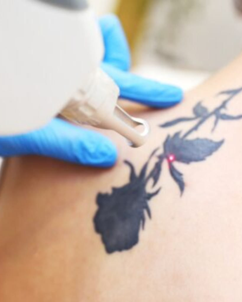 Tattoo Removal